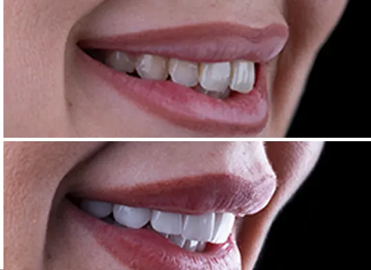 Veneers Stain Proof - Pure Harmony Dental Clinic
