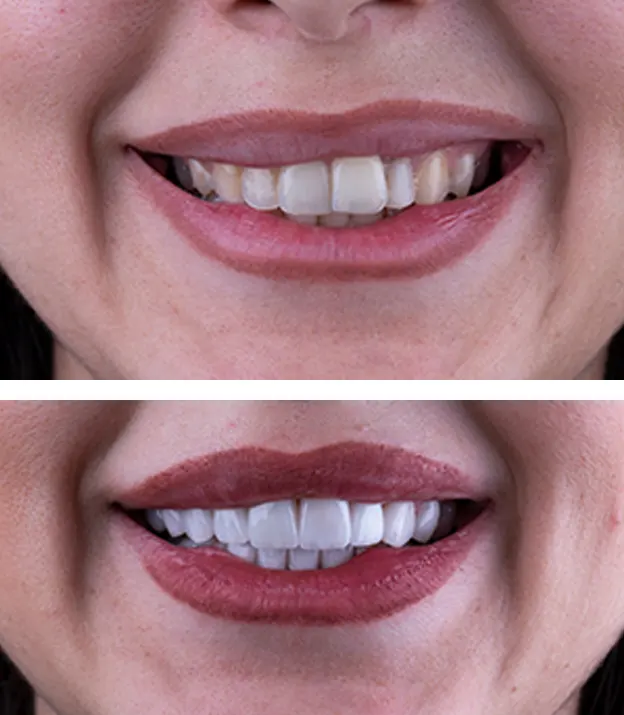 Before After of the Porcelain Veneers Process - Pure Harmony Dental Clinic