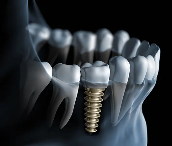 Cost and Advantages of Dental Implants - Pure Harmony Dental Clinic Harley Street