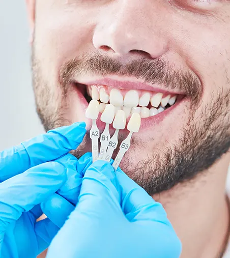 Composite Veneers Treatment Procedure - Pure Harmony Dental Clinic