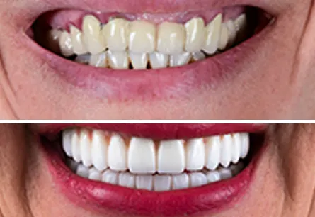 Before After of the Porcelain Veneers Why Pick? - Pure Harmony Dental Clinic